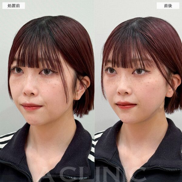 【二重顎を解消したい】脂肪溶解注射 vs 脂肪吸引、あなたに最適なのは？
