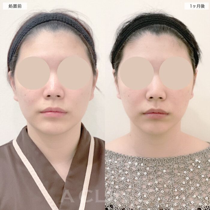 【症例１】顔の余白がなくなった！ 小顔ビフォーアフター