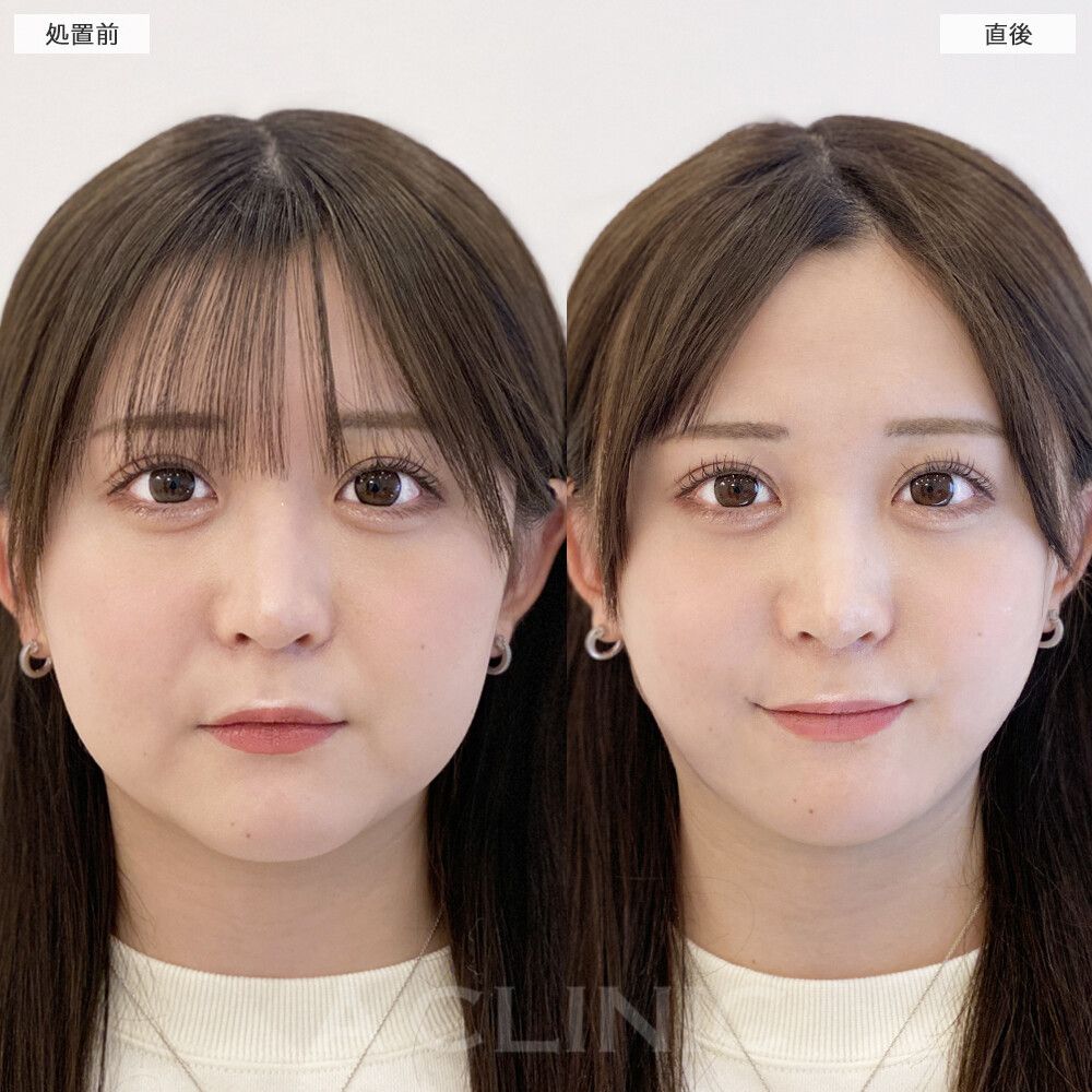 【症例１０】顔痩せは脂肪吸引が◎！ 小顔ビフォーアフター