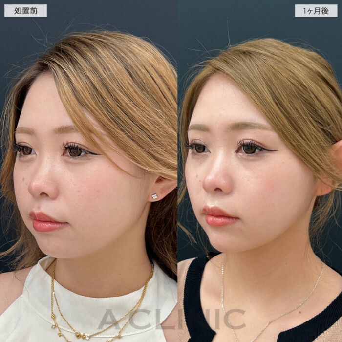 【症例２】丸顔からシャープな輪郭へ！ 小顔ビフォーアフター