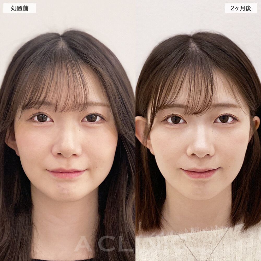 顔の脂肪吸引の症例写真