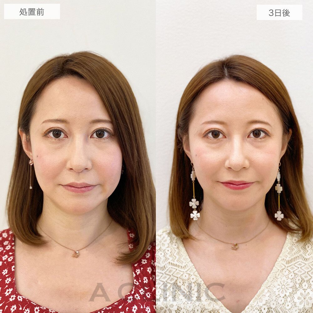 【症例５】左右差を解消して美しい輪郭へ！ 小顔ビフォーアフター