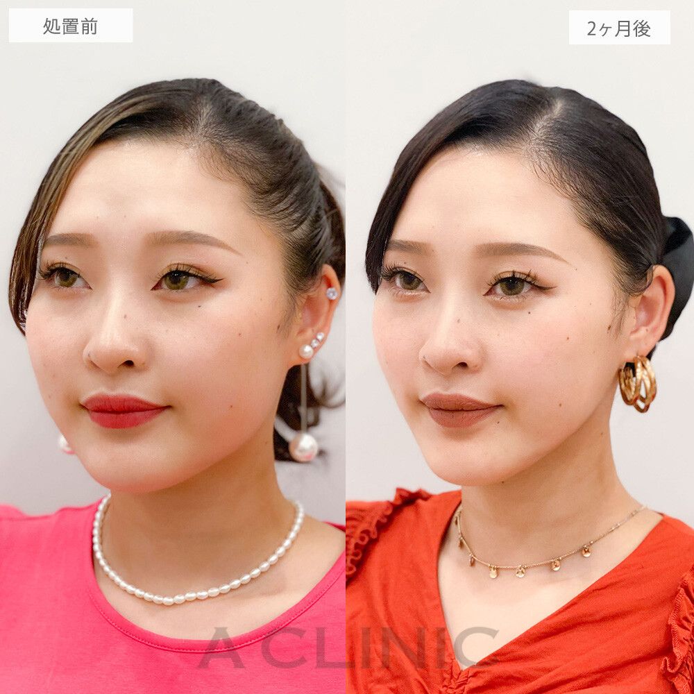 【症例９】シャープな小顔美人に！ ビフォーアフター