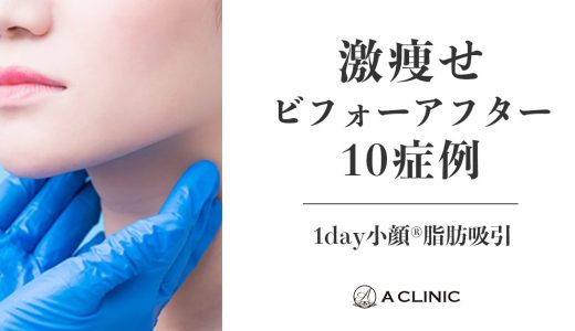 驚きの変化！顔痩せビフォーアフター10症例【1day小顔®脂肪吸引】