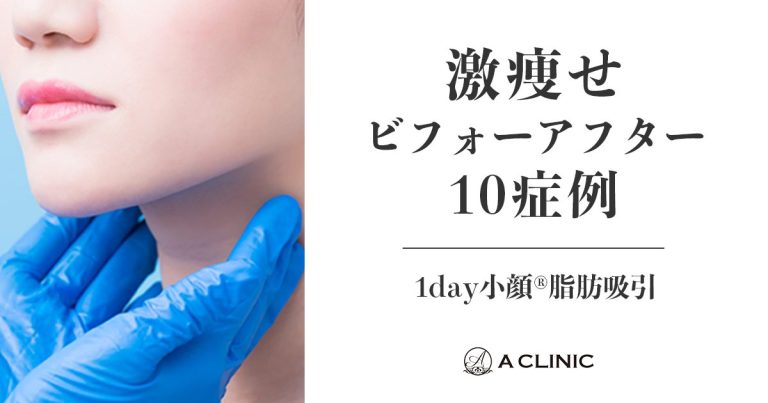 驚きの変化！顔痩せビフォーアフター10症例【1day小顔®脂肪吸引】