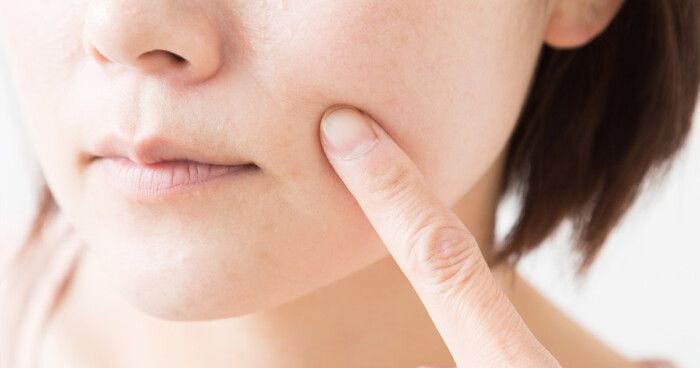 頬の脂肪吸引とは？