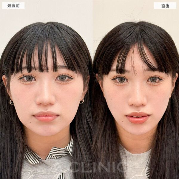 1day小顔®︎脂肪吸引はこんな方におすすめです！