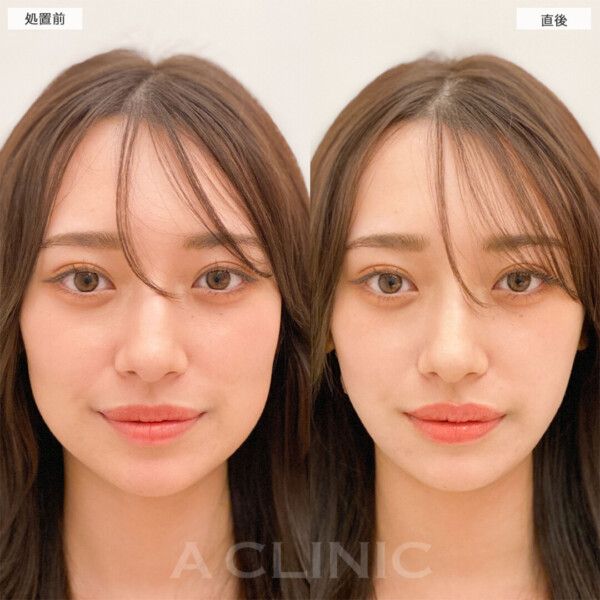 1day小顔®︎脂肪吸引はこんな方におすすめです！