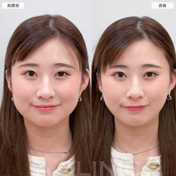 1day小顔®︎脂肪吸引はこんな方におすすめです！