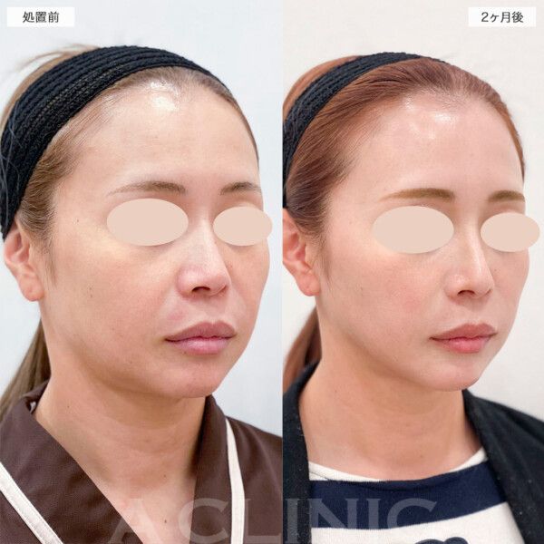頬の脂肪吸引＋リフトアップ！1day小顔®︎脂肪吸引で若々しいフェイスラインへ