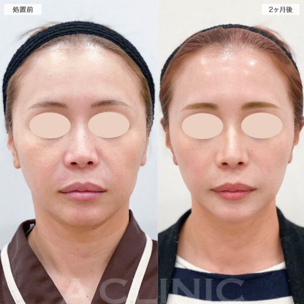 頬の脂肪吸引＋リフトアップ！1day小顔®︎脂肪吸引で若々しいフェイスラインへ