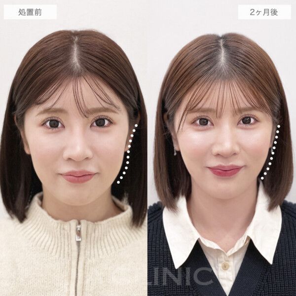 エラ下脂肪除去も1day小顔®脂肪吸引がおすすめ!