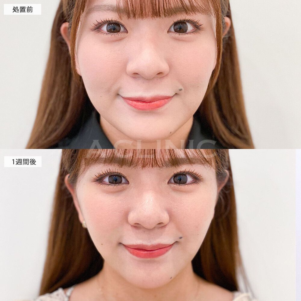 顔痩せビフォーアフター②