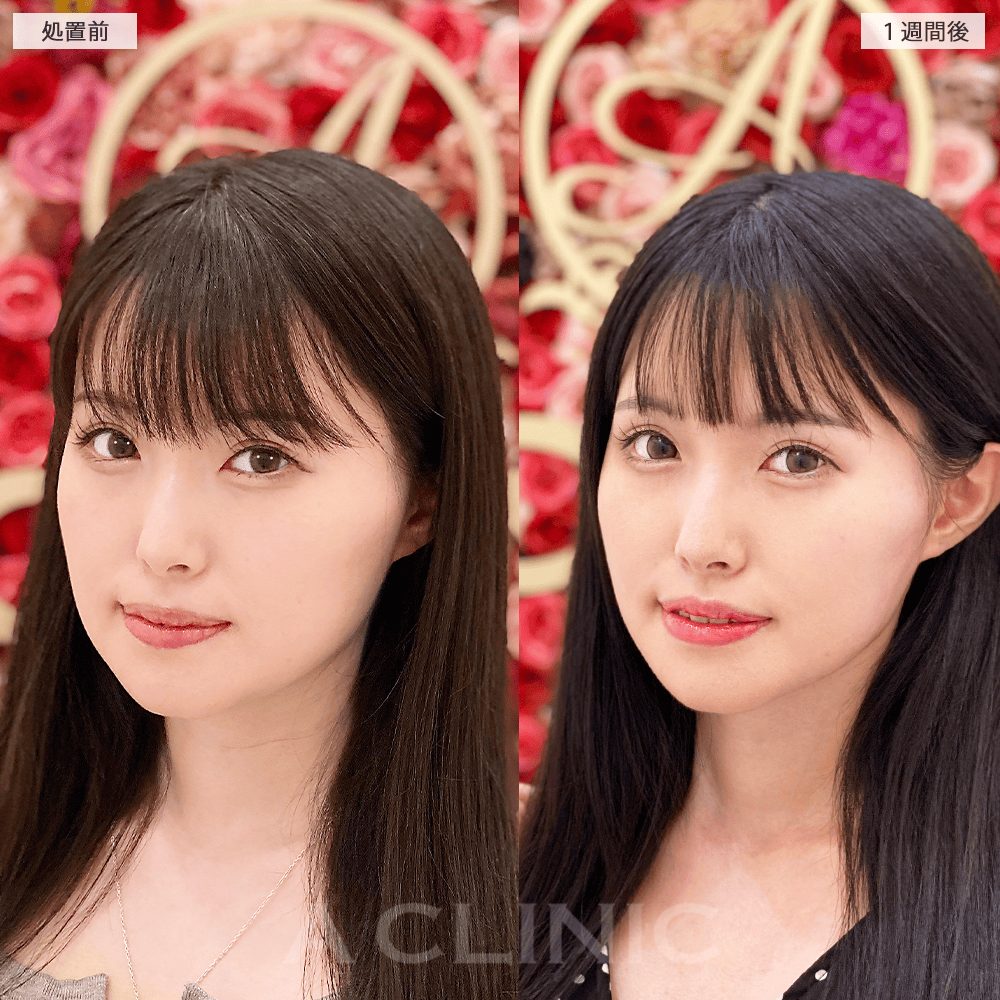 顔痩せビフォーアフター③