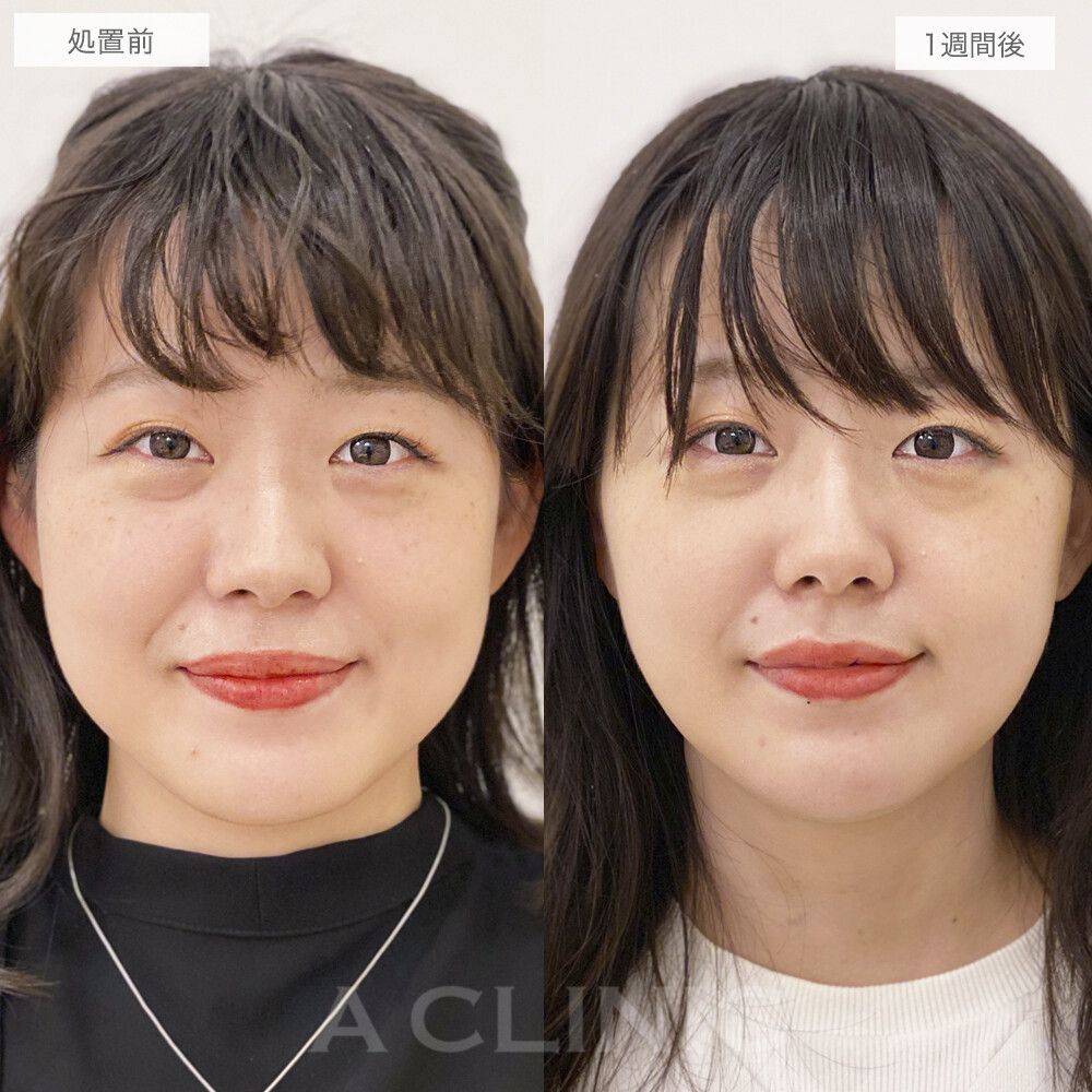 顔痩せビフォーアフター④
