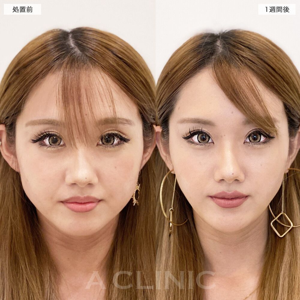顔痩せビフォーアフター①