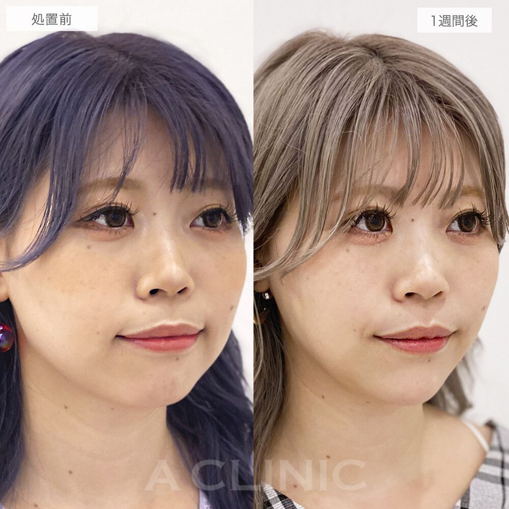 顔痩せビフォーアフター⑤