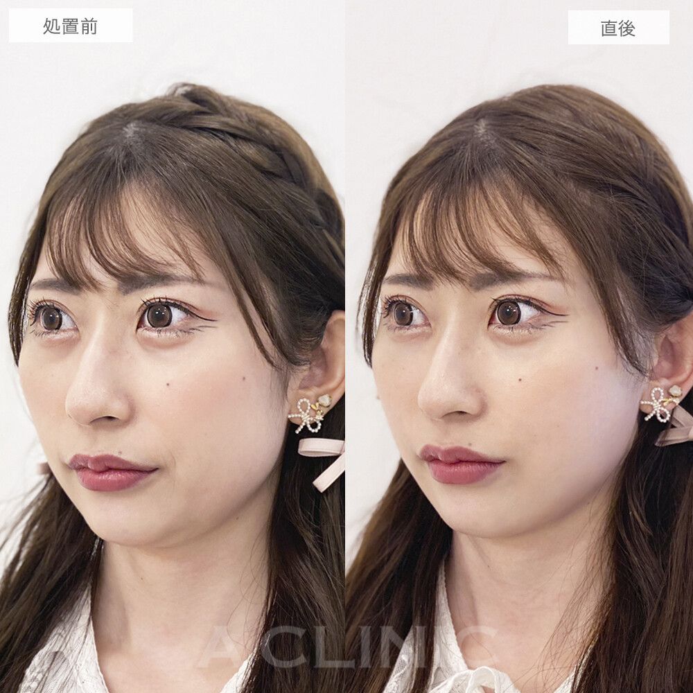 1day小顔®︎脂肪吸引の症例紹介