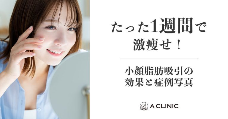 たった1週間で顔痩せ！小顔脂肪吸引の効果と症例写真