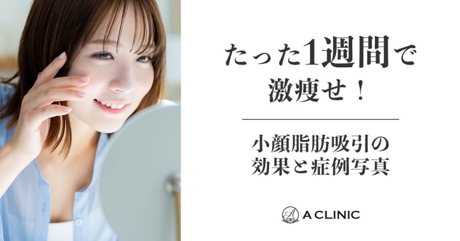 たった1週間で顔痩せ！小顔脂肪吸引の効果と症例写真