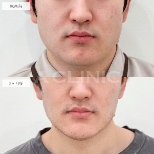 男性の1day小顔脂肪吸引の症例写真