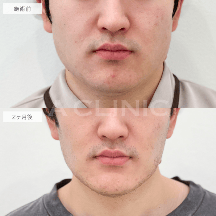 1day小顔脂肪吸引の男性の症例写真