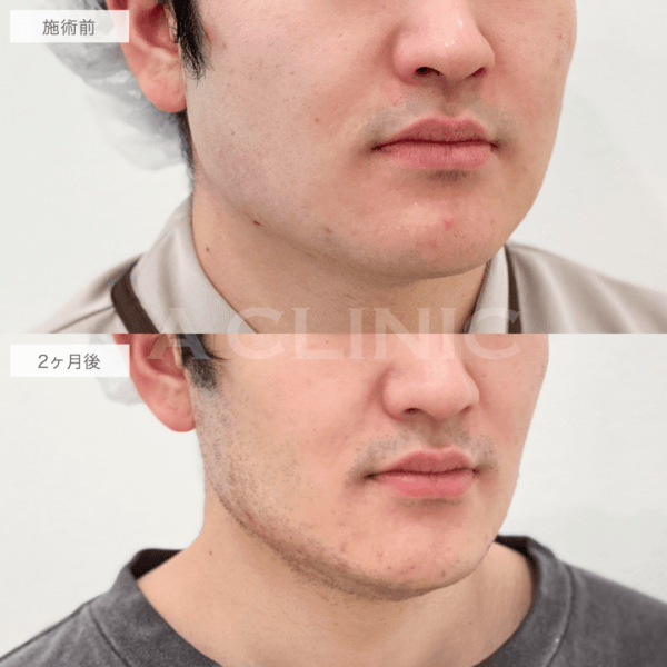 1day小顔脂肪吸引の男性の症例写真