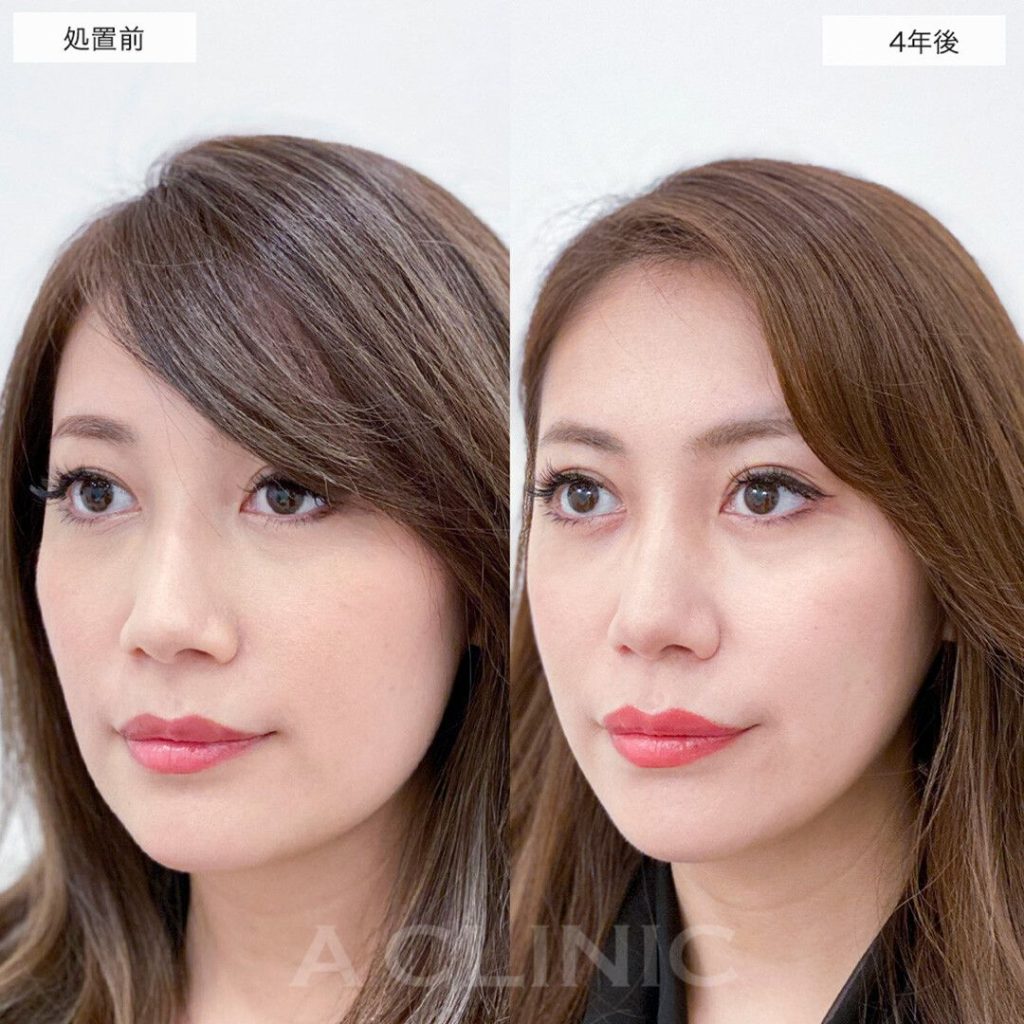 1day小顔®脂肪吸引の症例写真