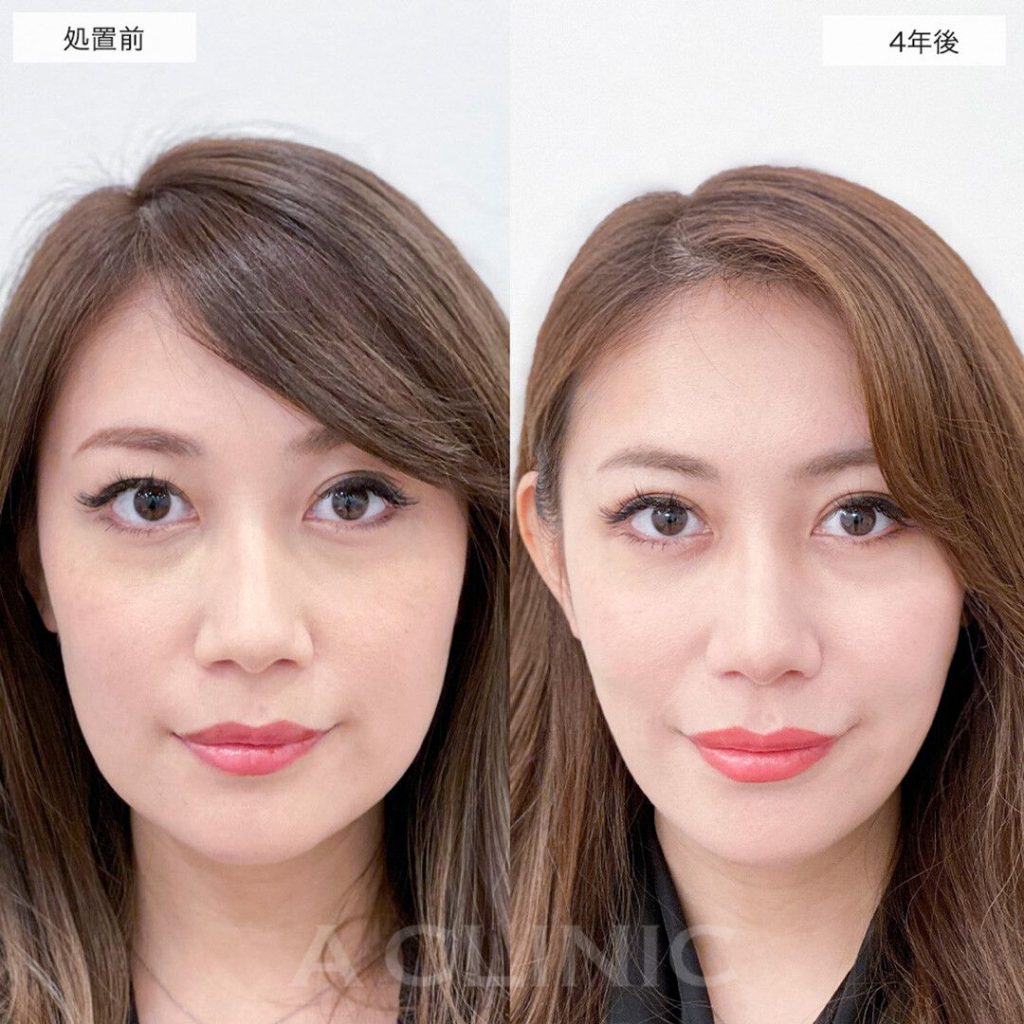 1day小顔®脂肪吸引の症例写真