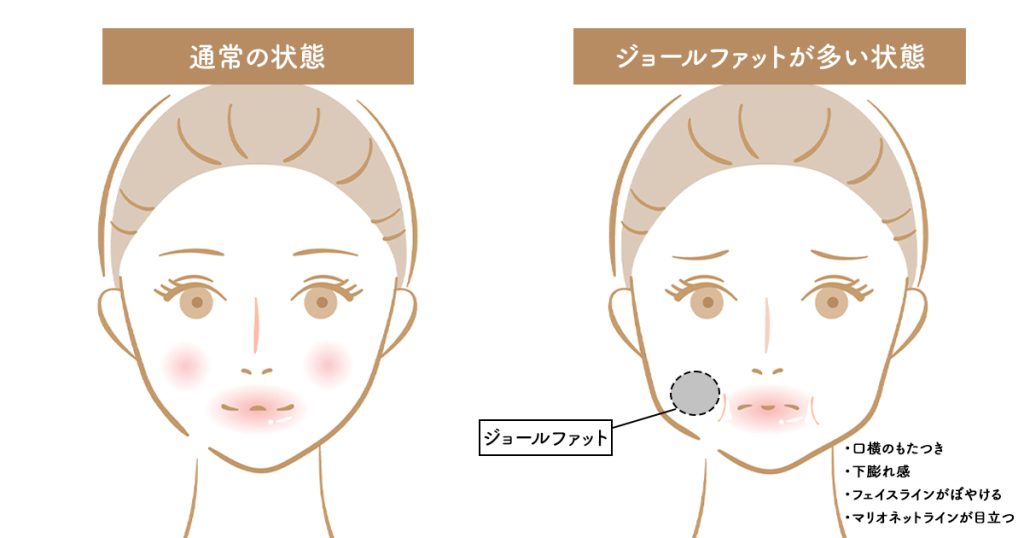 ジョールファット