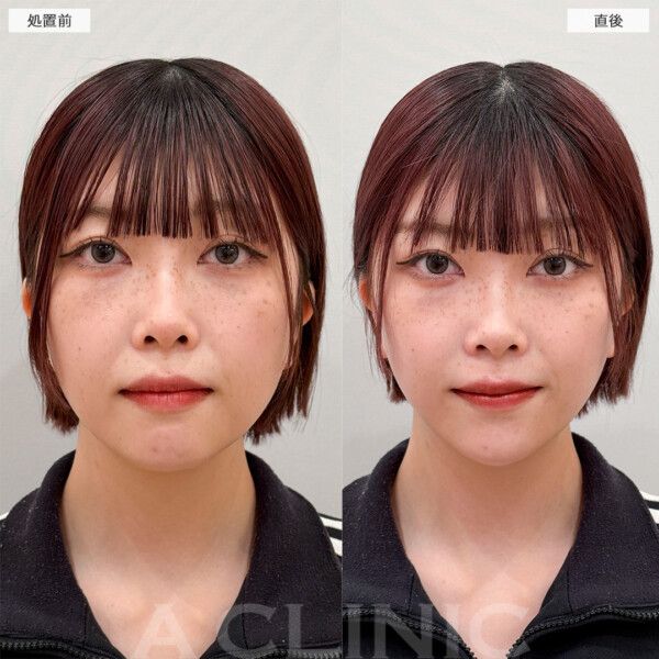 1day小顔脂肪吸引の症例写真