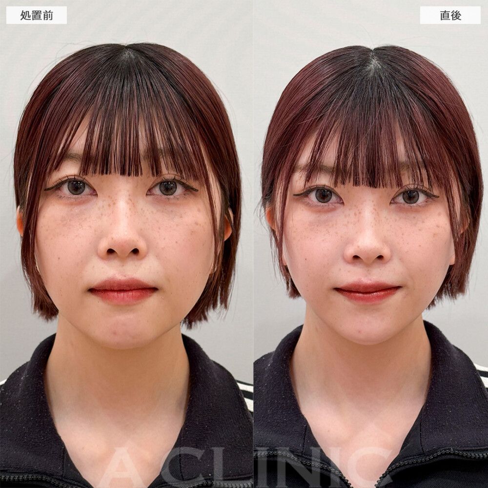 「1day小顔®脂肪吸引」の症例写真