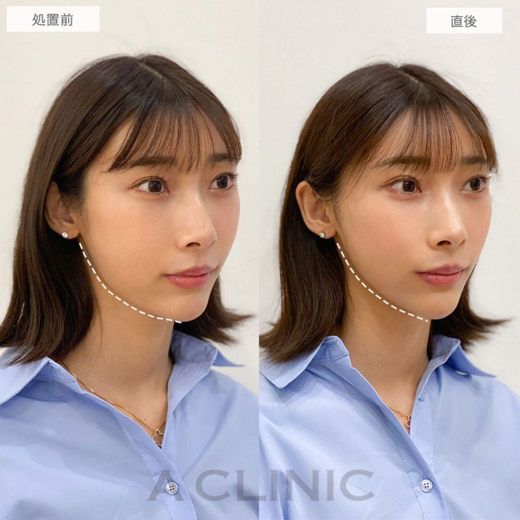 Aスレッド®を1部位(左右1本ずつ、合計2本)を挿入