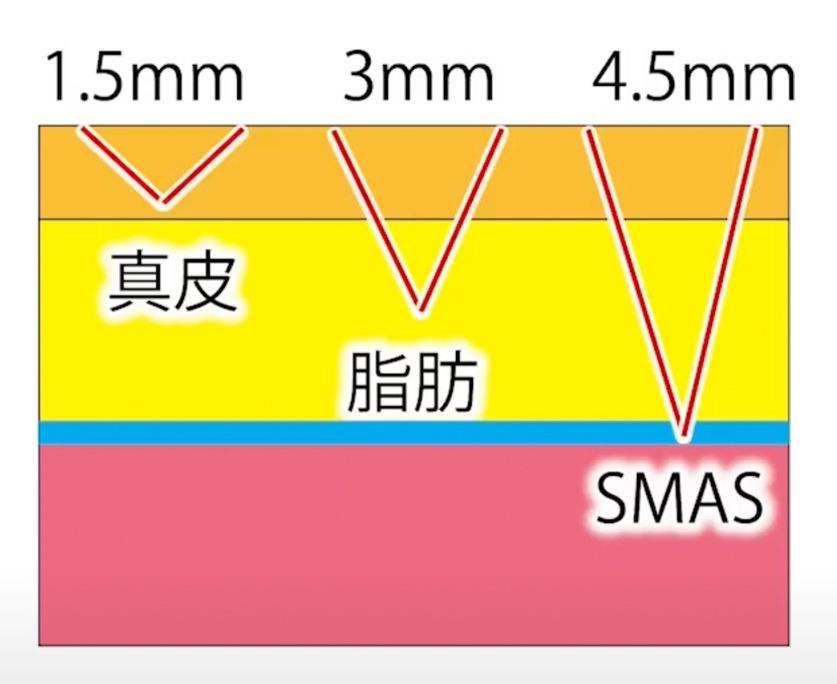 HIFU(ハイフ)の仕組みについて