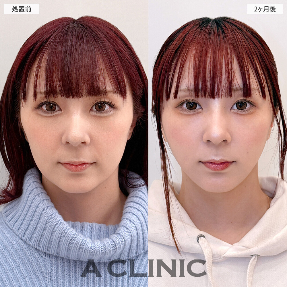 1day小顔®脂肪吸引の症例写真