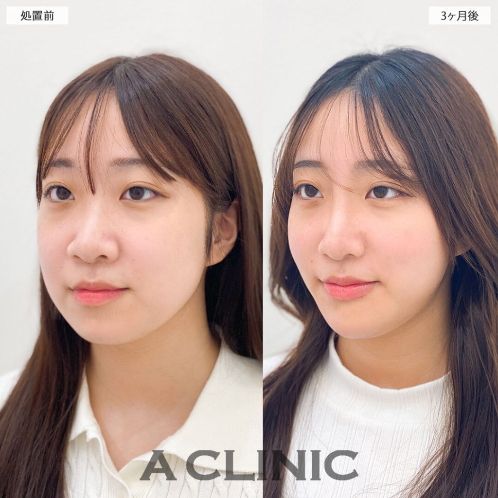 1day小顔脂肪吸引の症例写真