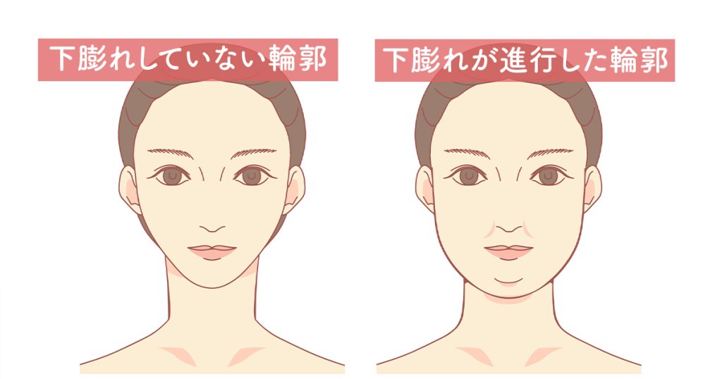 下膨れの状態を説明