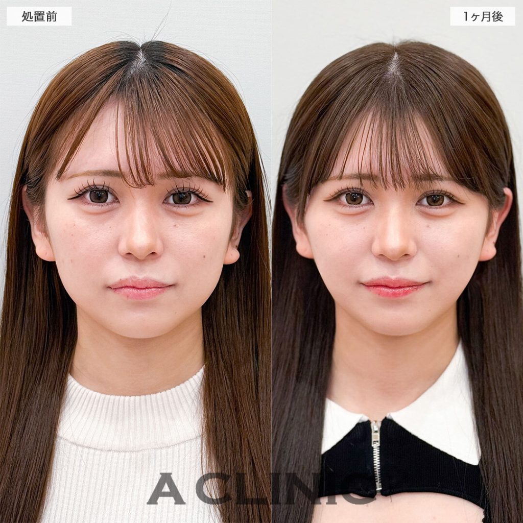 顔の脂肪吸引の症例写真