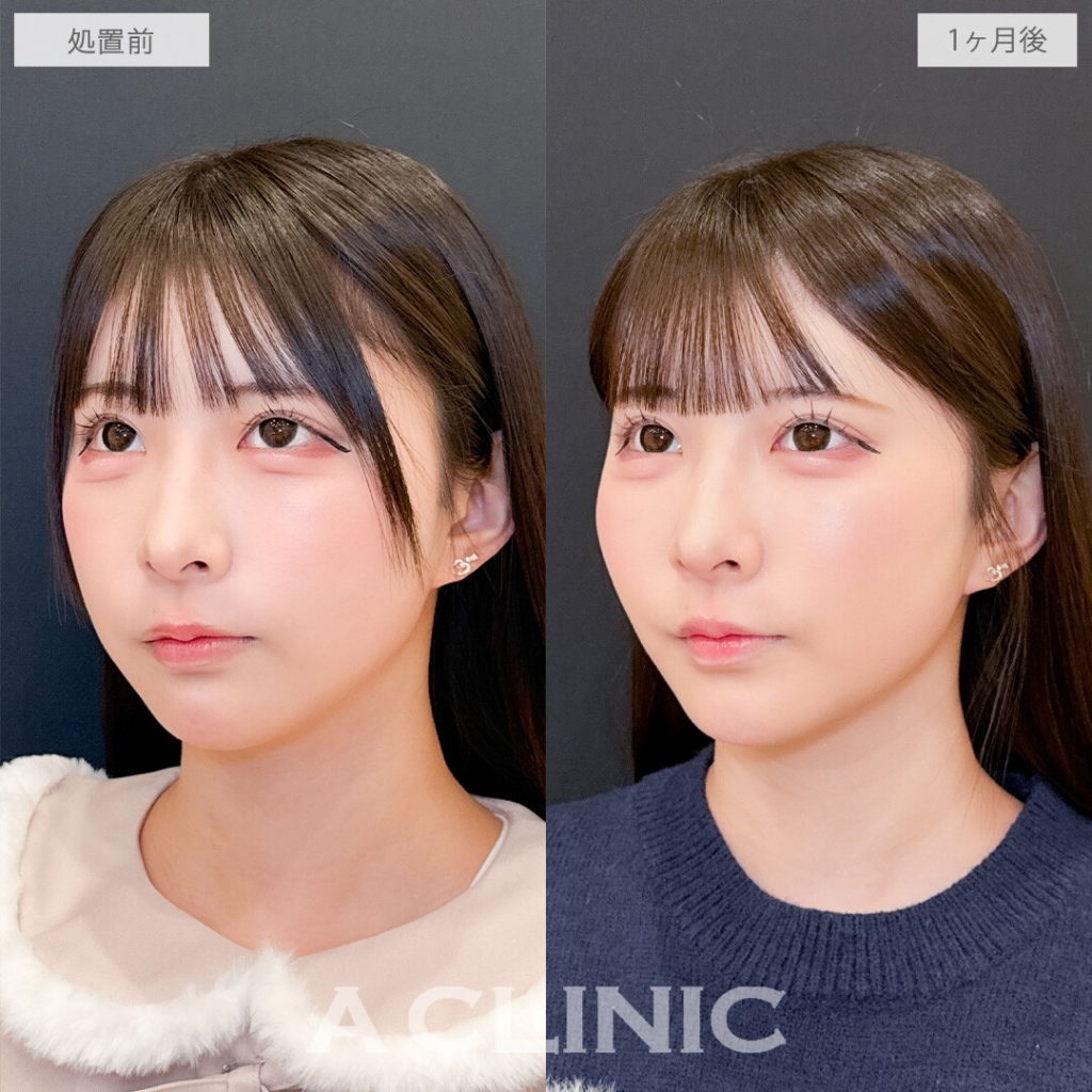 Aスレッド®2部位+頬へのヒアルロン酸注入