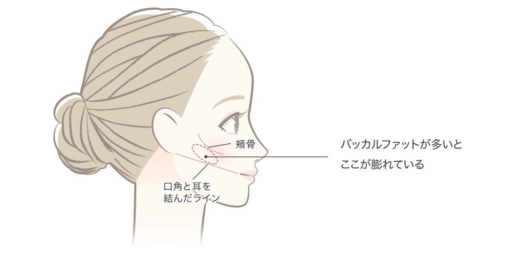 バッカルファット