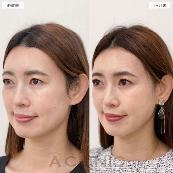 1day小顔®︎脂肪吸引の症例写真