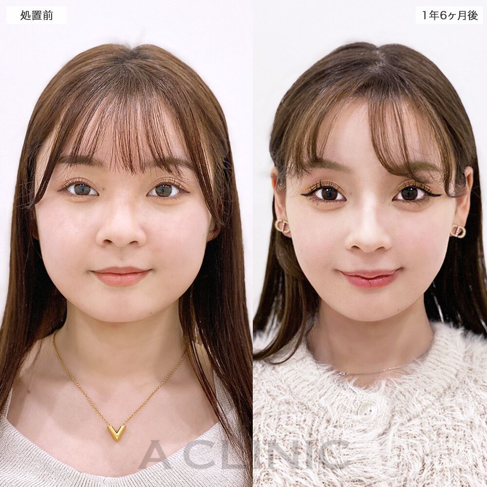 1day小顔脂肪吸引の症例写真