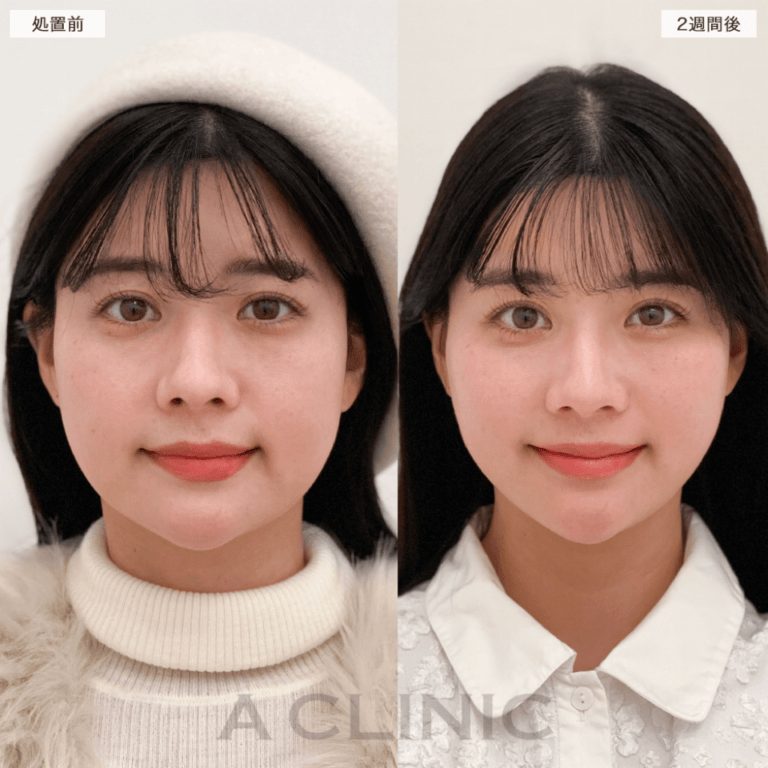 1day小顔®︎脂肪吸引の症例写真