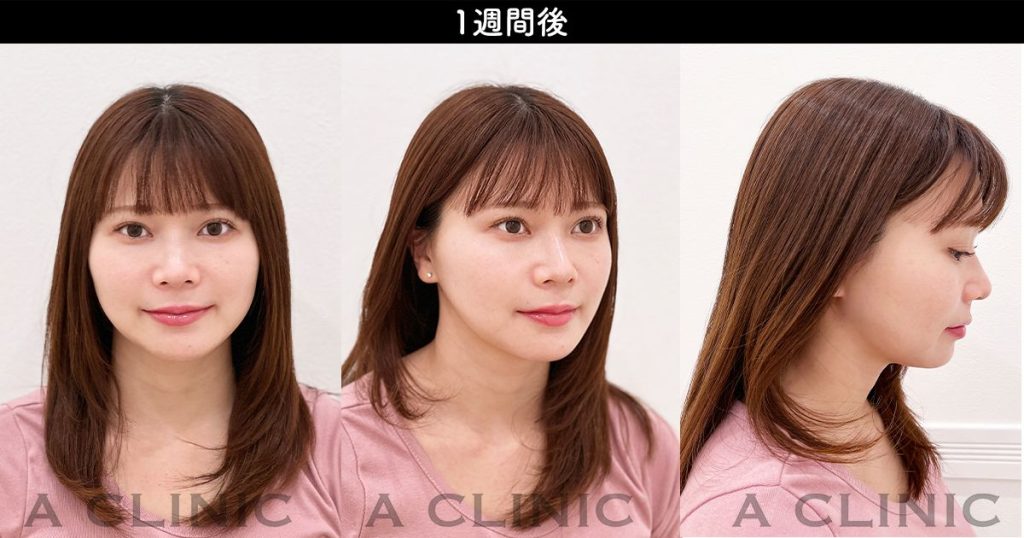 顔の脂肪吸引のダウンタイム経過 施術1週間後