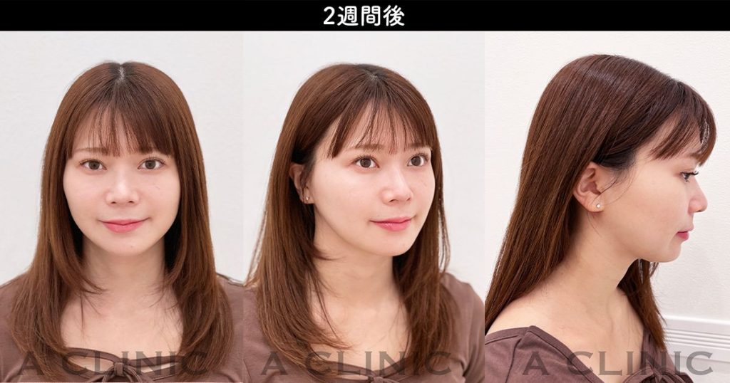 顔の脂肪吸引のダウンタイム経過 施術2週間後