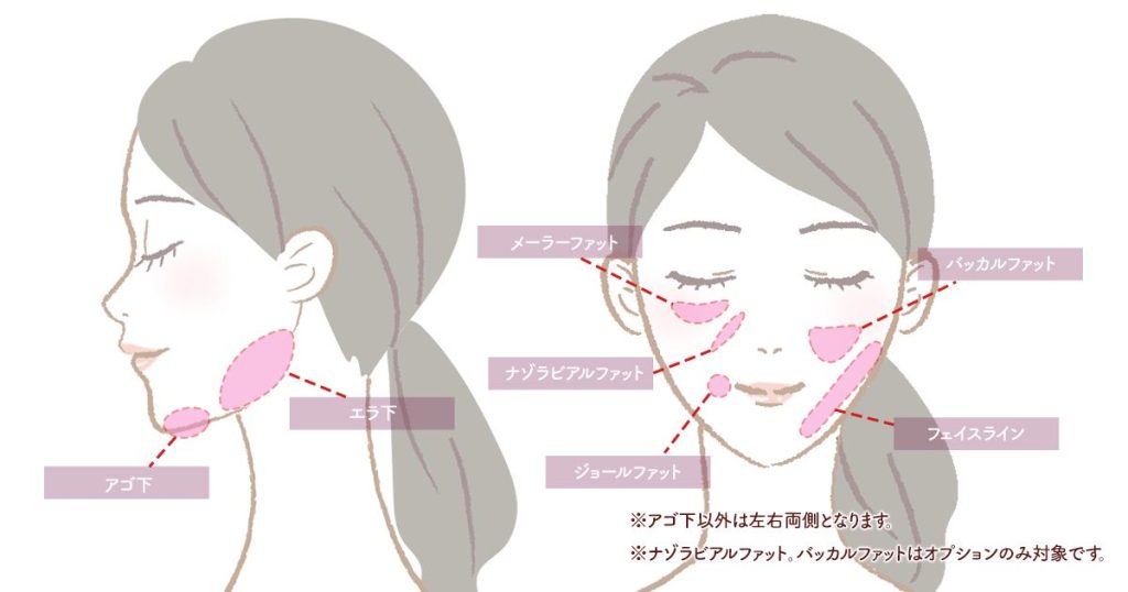 顔の脂肪吸引について