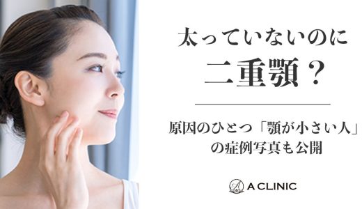 【太っていないのに二重顎！？】原因のひとつ「顎が小さい人」の症例写真も公開