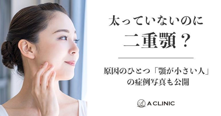 【太っていないのに二重顎！？】原因のひとつ「顎が小さい人」の症例写真も公開