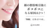 顔の脂肪吸引後にボコボコになる原因は２つ！「拘縮」とあと１つは…