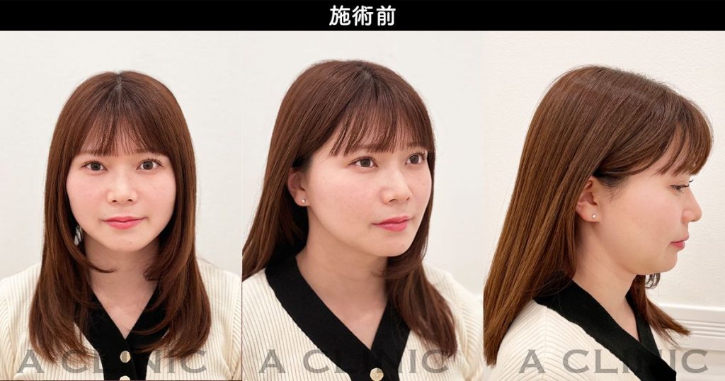 顔の脂肪吸引のダウンタイム経過 施術前